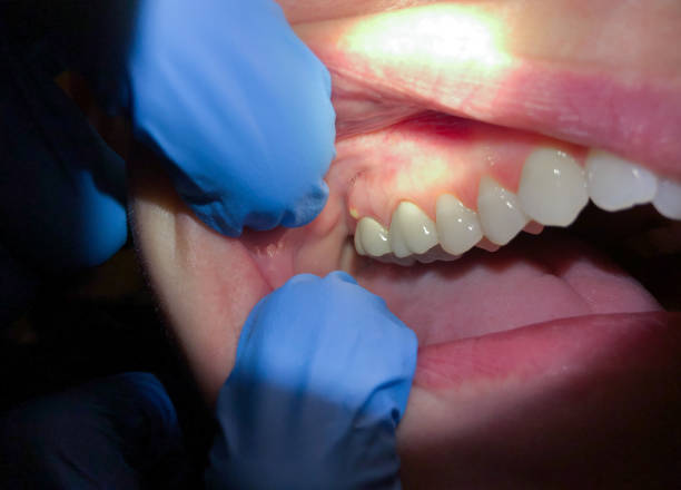 Best Emergency Wisdom Teeth Removal in Santa Moni, CA
